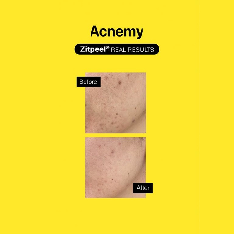 Peeling delicat pentru pielea predispusa la acnee zitpeel