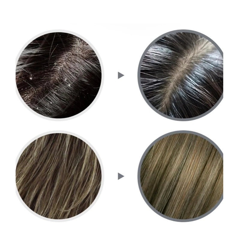 Sampon anti-matreata si anti-grasime anti-dandruff shampoo